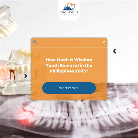 Wisdom Teeth Removal in the Philippines – Costs, Procedure.